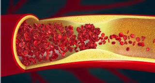 Arteriosklerose kann sich wieder zurückbilden